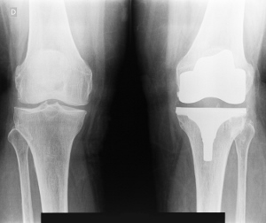 膝頭のレントゲン写真